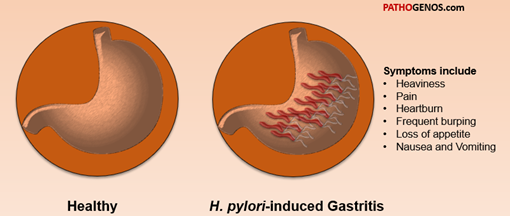 H. pylori bacterium