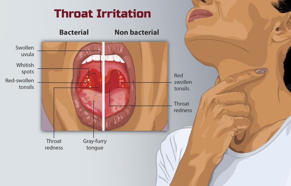 Depiction of a person who has an irritated throat. Source: https://www.myupchar.com/en | Wikimedia Commons.