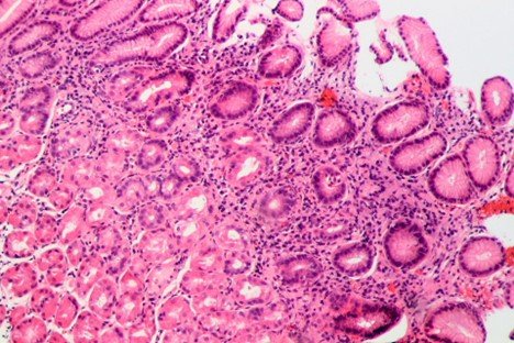 Gastritis due to H. pylori. Source: Patho | Wikimedia Commons.