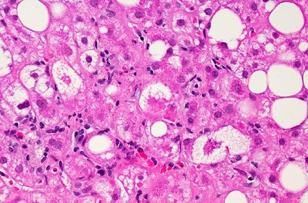 Figure 3. Liver tissue with non-alcoholic fatty liver disease (NAFLD). Source: NIH Image Gallery | Flickr