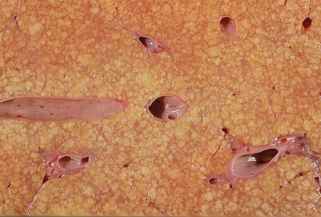 Liver cirrhosis. Source: Narraburra | Wikimedia Commons.