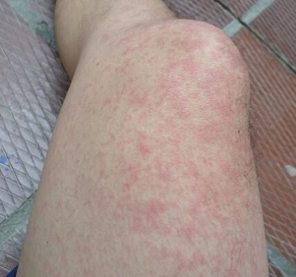 Chikungunya infection in Colombia