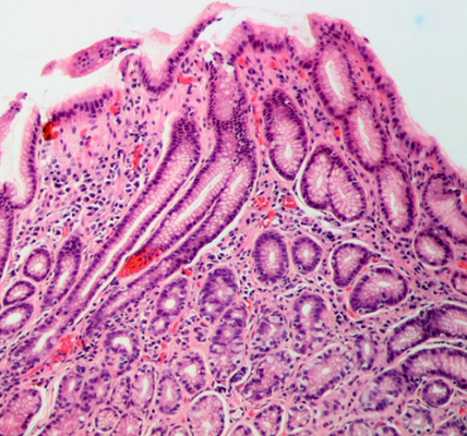gastritis due to helicobacter pylori
