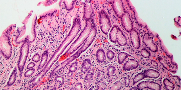 gastritis due to helicobacter pylori