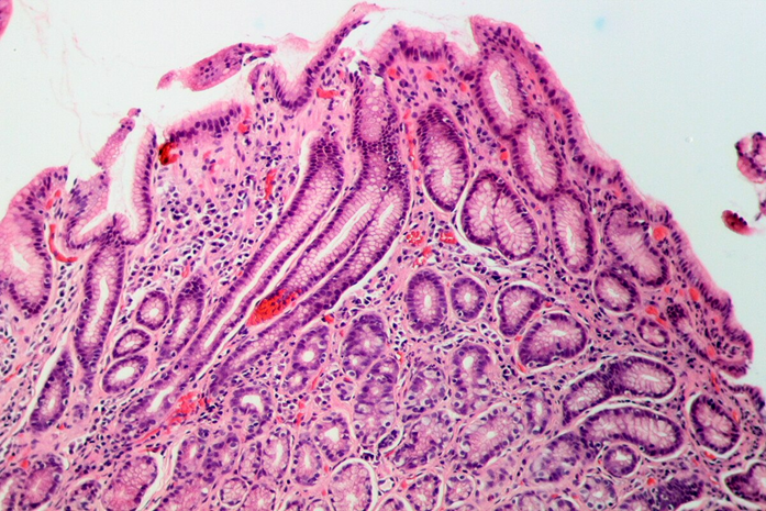 gastritis due to helicobacter pylori
