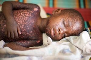 child with mealses infection