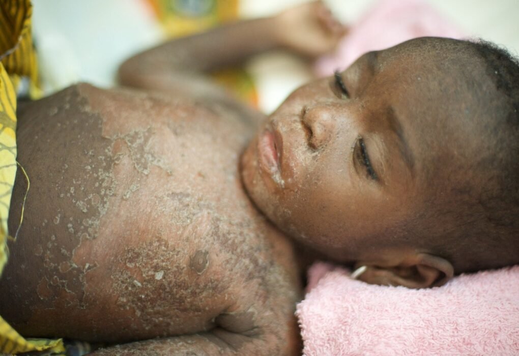 child infected with measles