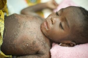 child infected with measles
