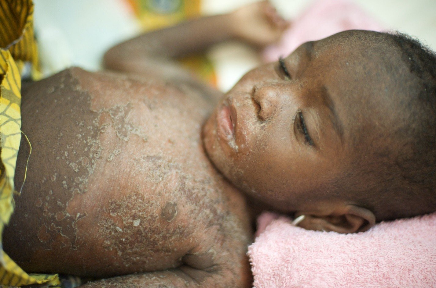 child infected with measles