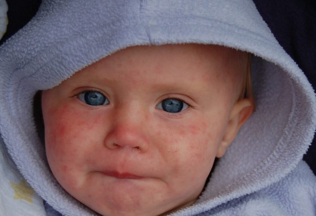 baby with measles