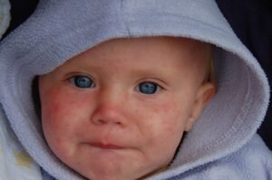 baby with measles