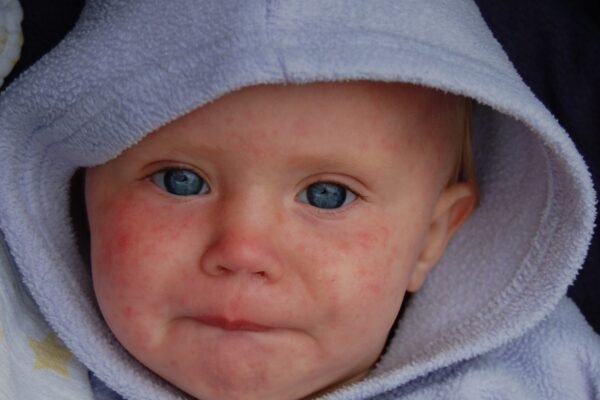 baby with measles