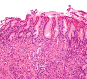 gastric cancer due to helicobacter pylori
