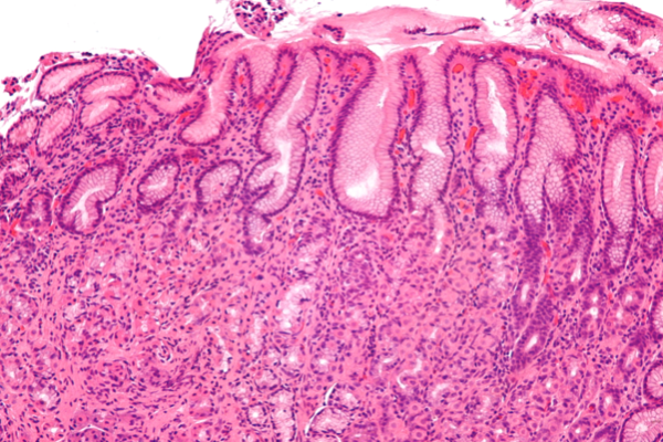 gastric cancer due to helicobacter pylori
