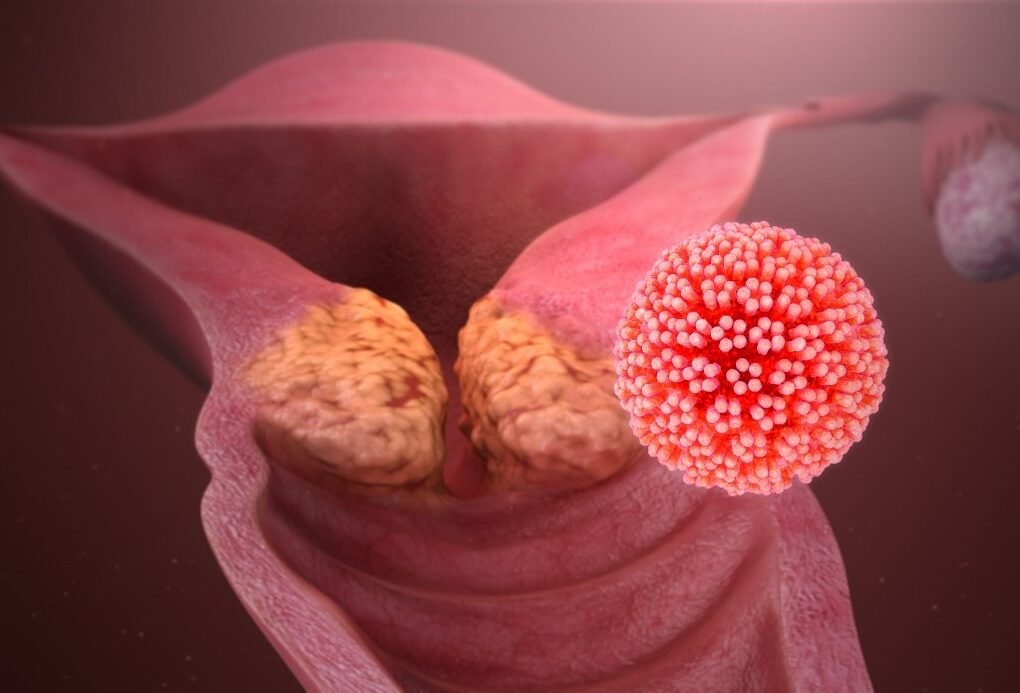 cervical cancer by HPV