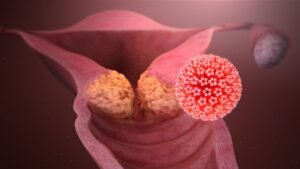 cervical cancer by HPV