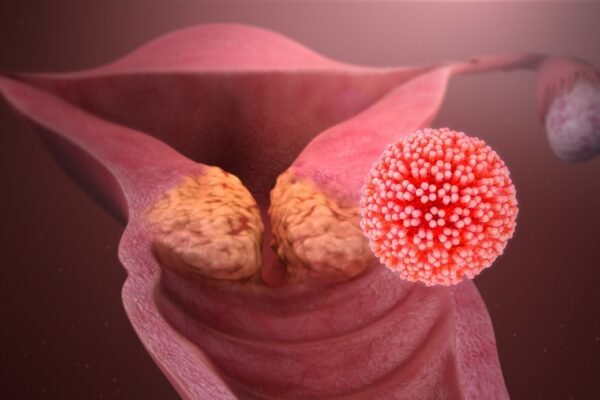 cervical cancer by HPV